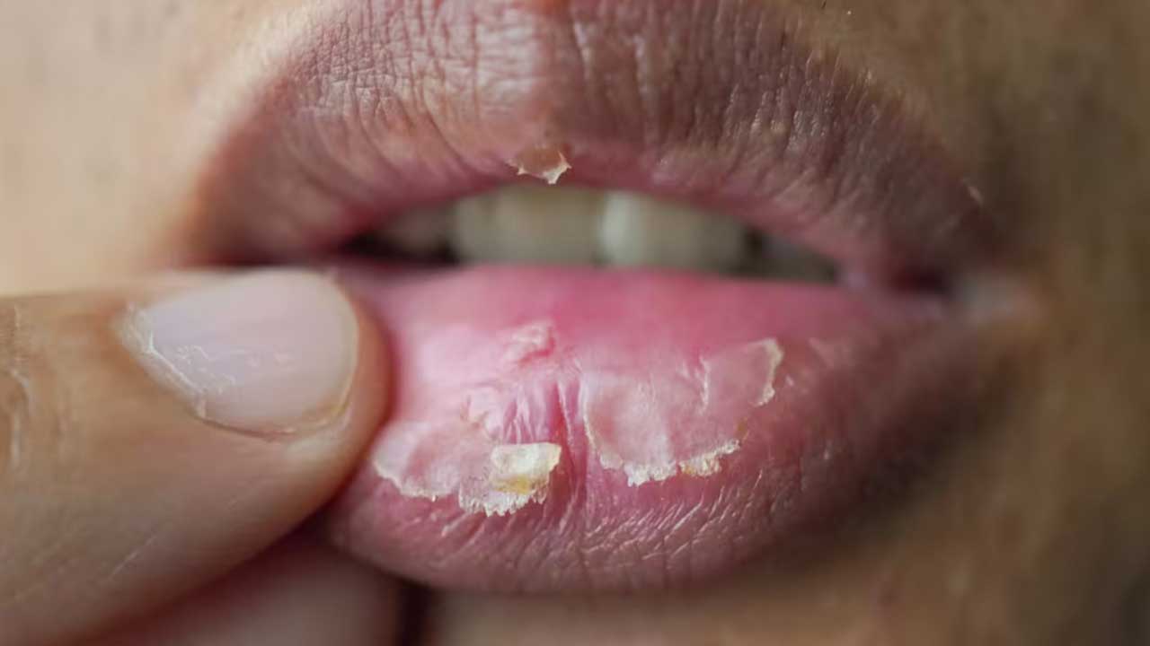 ترک لب - معرفی 6 راهکار برای خلاصی از ترک خوردگی لب