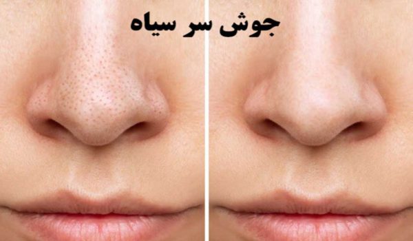 جوش سر سیاه چیست؟ معرفی 5 روش جلوگیری