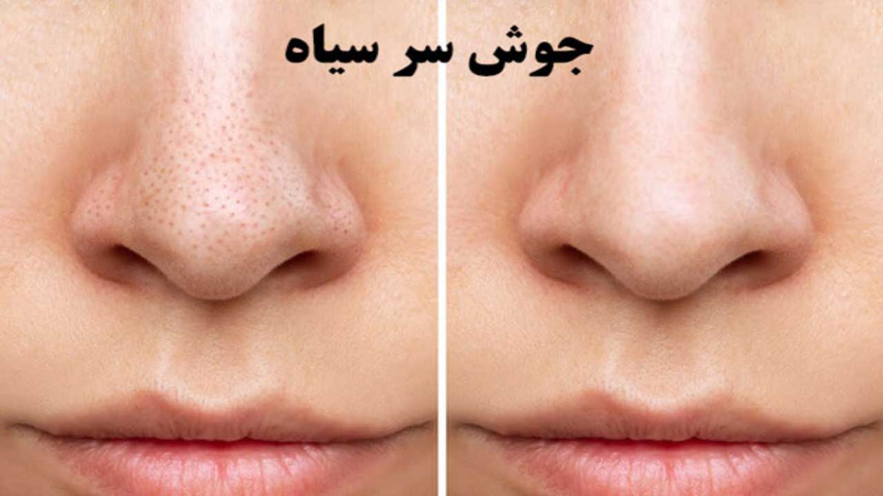 جوش سر سیاه چیست؟ معرفی 5 روش جلوگیری
