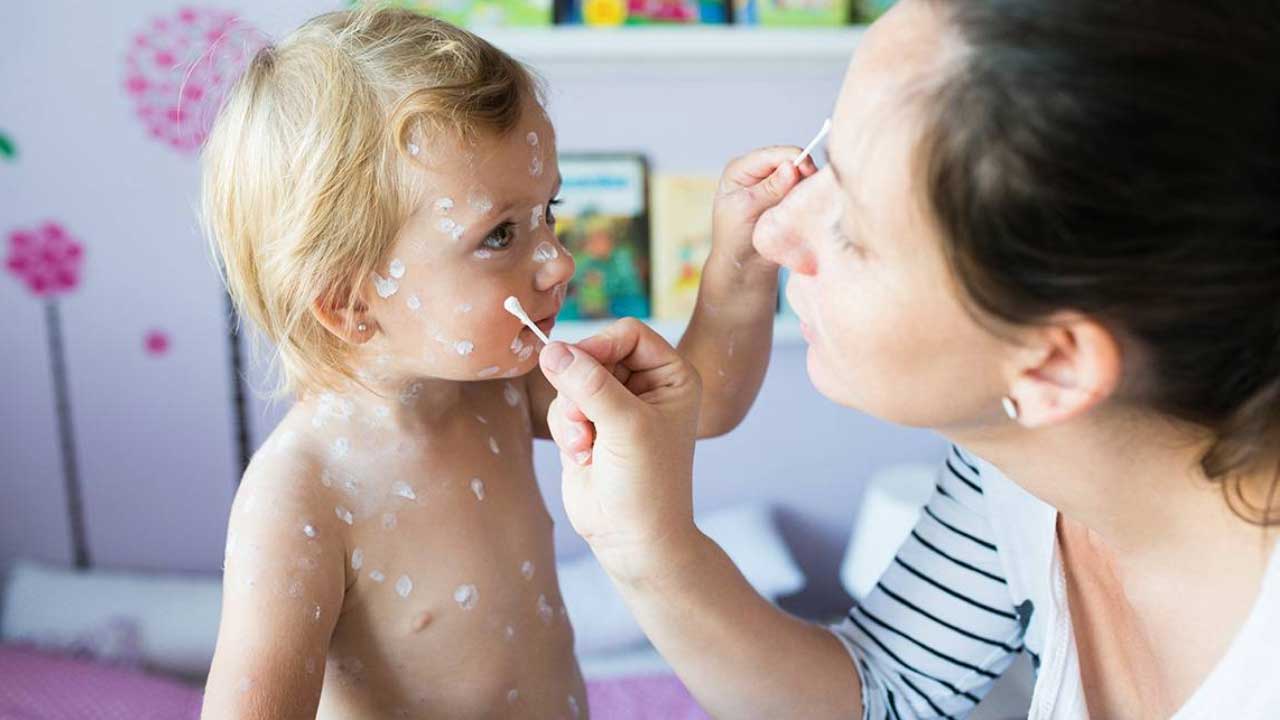 زگیل دوران کودکی - معرفی 3 روش درمان زگیل های دوران کودکی