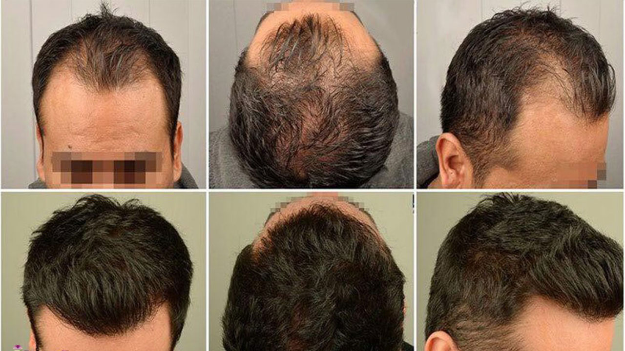 بهترین دکتر کاشت مو در اراک – بررسی 4 نکته مهم