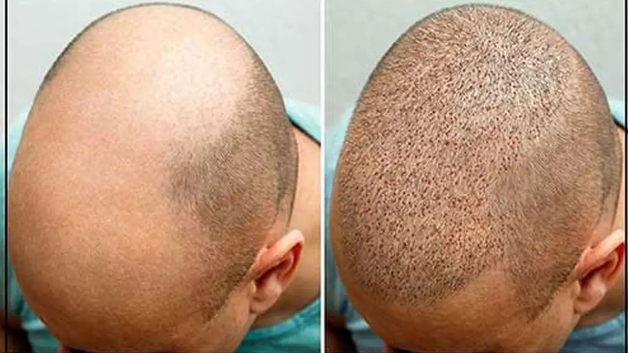بهترین دکتر کاشت مو در اراک – بررسی 4 نکته مهم