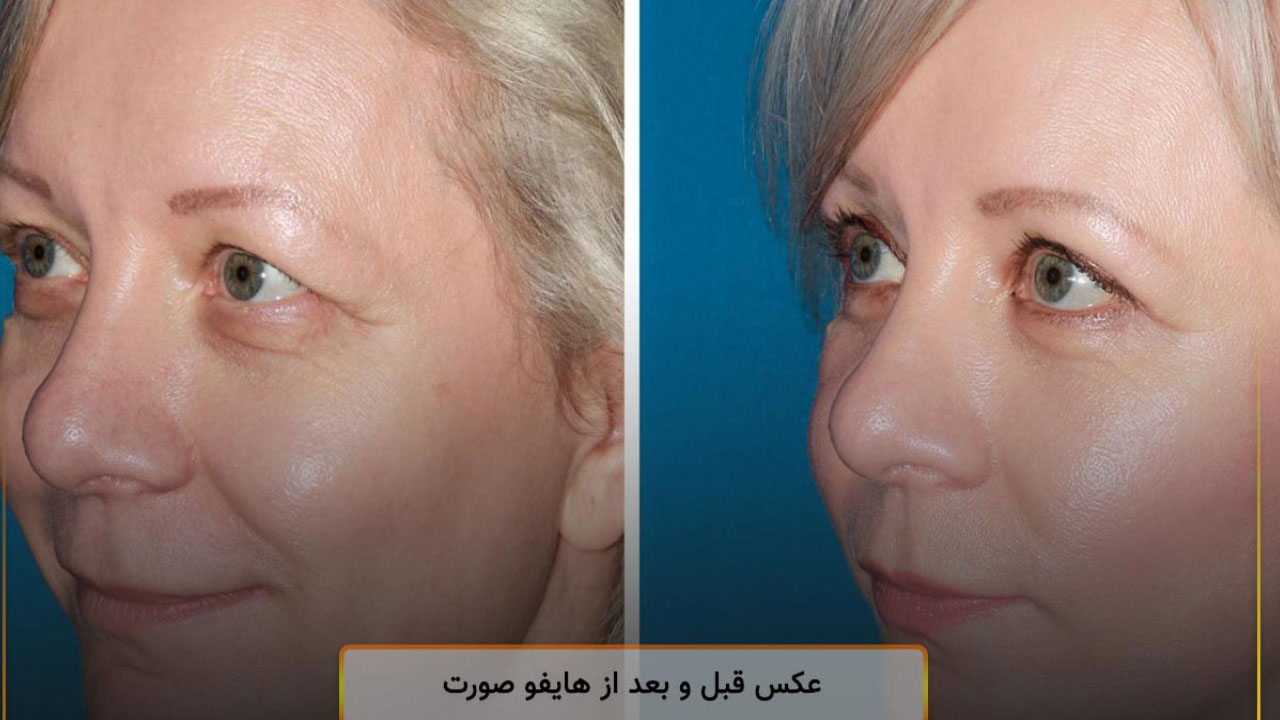 جوانسازی پوست با هایفوتراپی – بررسی 6 نکته مهم