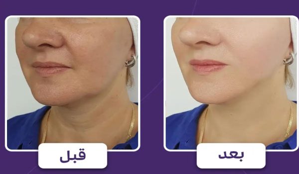 جوانسازی پوست با هایفوتراپی – بررسی 6 نکته مهم