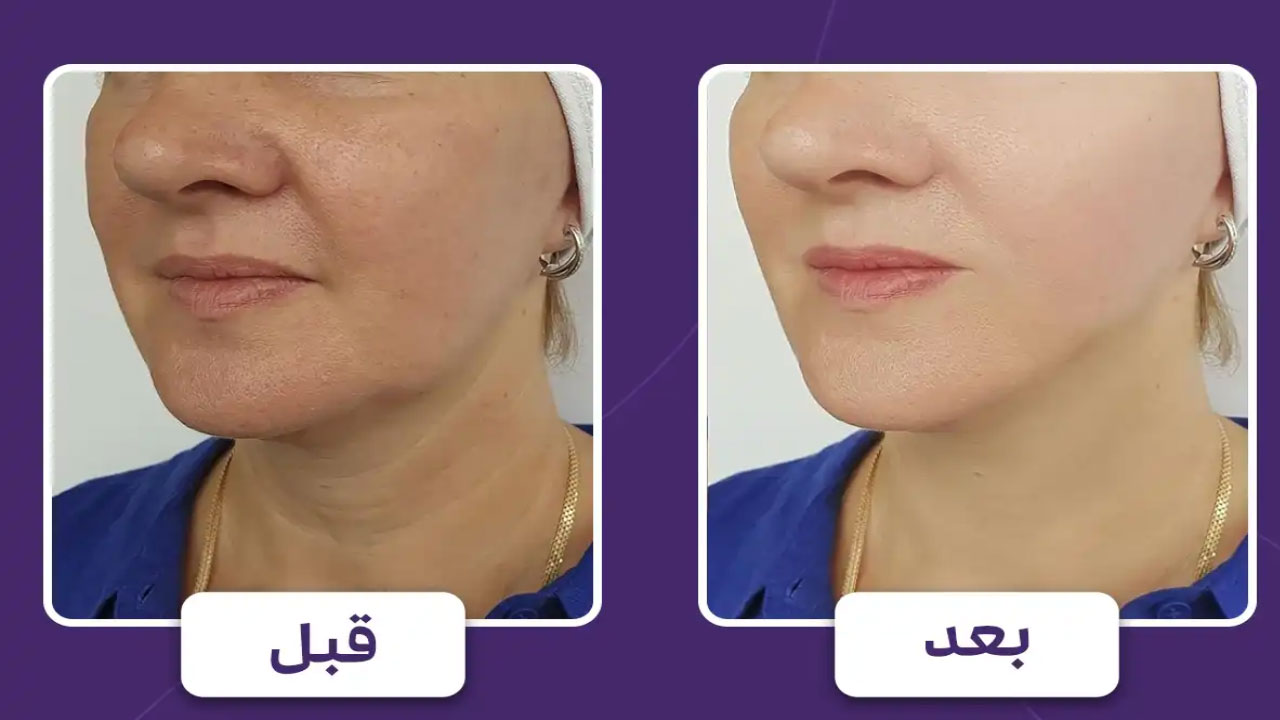 جوانسازی پوست با هایفوتراپی – بررسی 6 نکته مهم