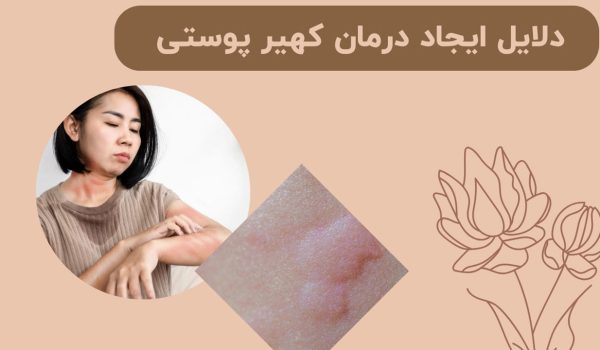 علت و درمان کهیر پوستی راهنمای کامل – بررسی 4 نکته مهم
