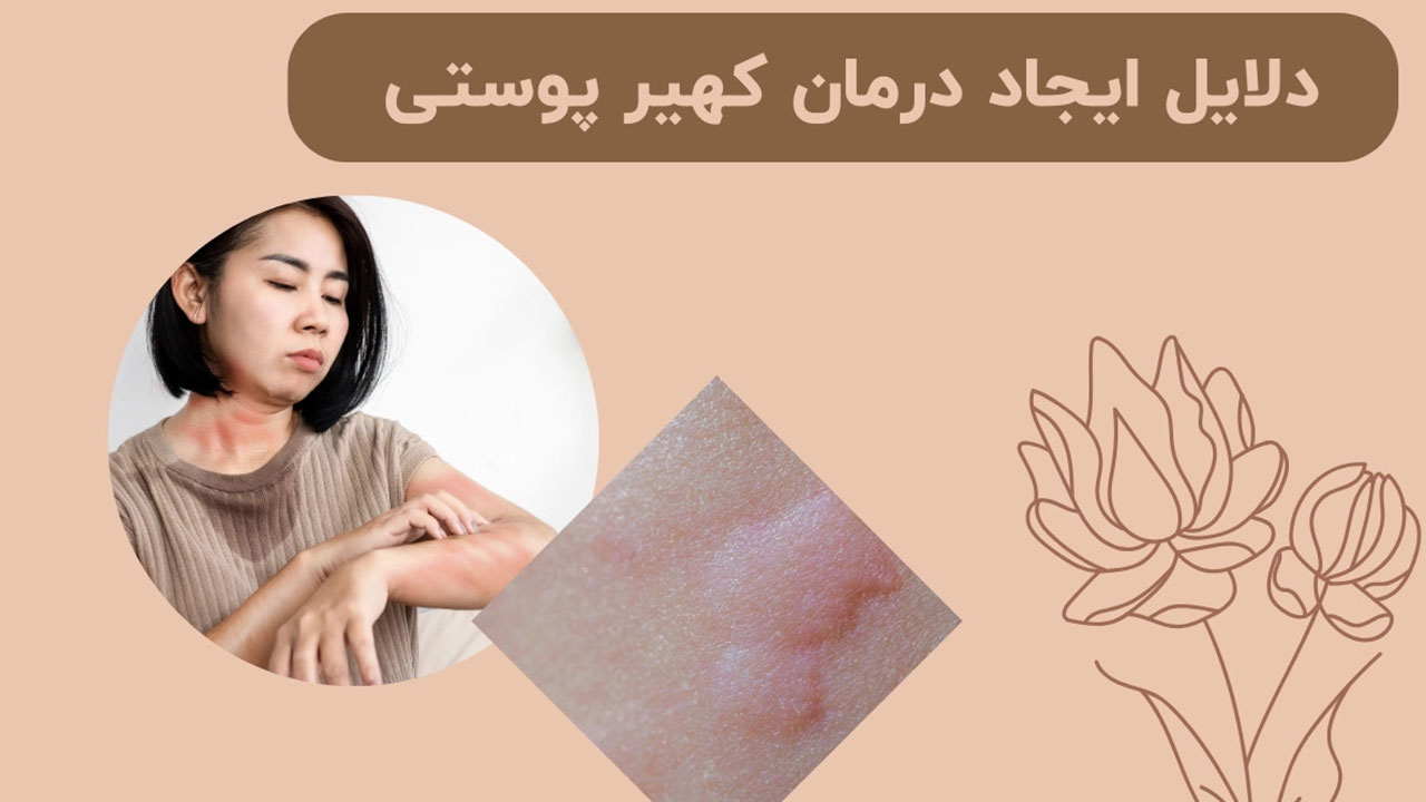 علت و درمان کهیر پوستی راهنمای کامل – بررسی 4 نکته مهم