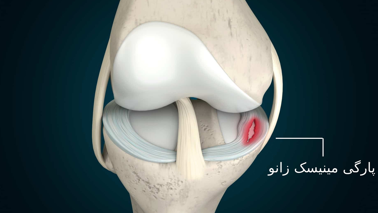 درمان آسیب مینیسک زانو – بررسی ۳ نکته مهم