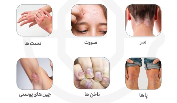 درمان پسوریازیس علل علائم و روش های درمانی – بررسی 5 نوع اصلی