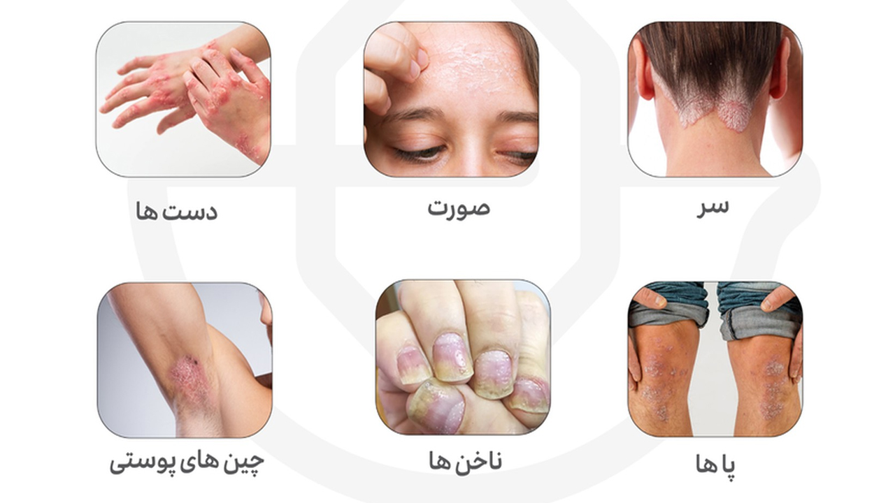 درمان پسوریازیس علل علائم و روش های درمانی – بررسی 5 نوع اصلی