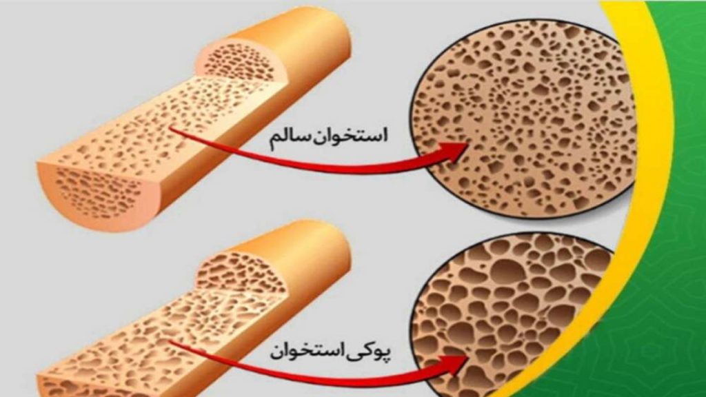 درمان پوکی استخوان – بررسی 4 نکته مهم