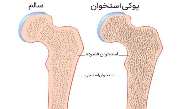 درمان پوکی استخوان – بررسی 4 نکته مهم