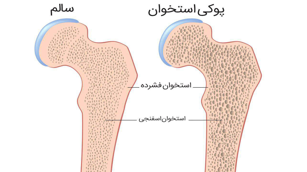 درمان پوکی استخوان – بررسی 4 نکته مهم