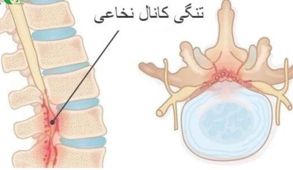 درمان تنگی کانال نخاعی - بررسی 5 نکته مهم