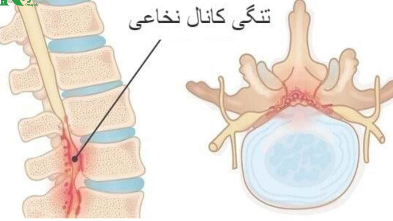 درمان تنگی کانال نخاعی - بررسی 5 نکته مهم