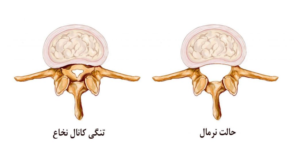 درمان تنگی کانال نخاعی - بررسی 5 نکته مهم