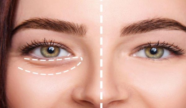 فیلر زیر چشم در اراک – بررسی 4 نکته مهم