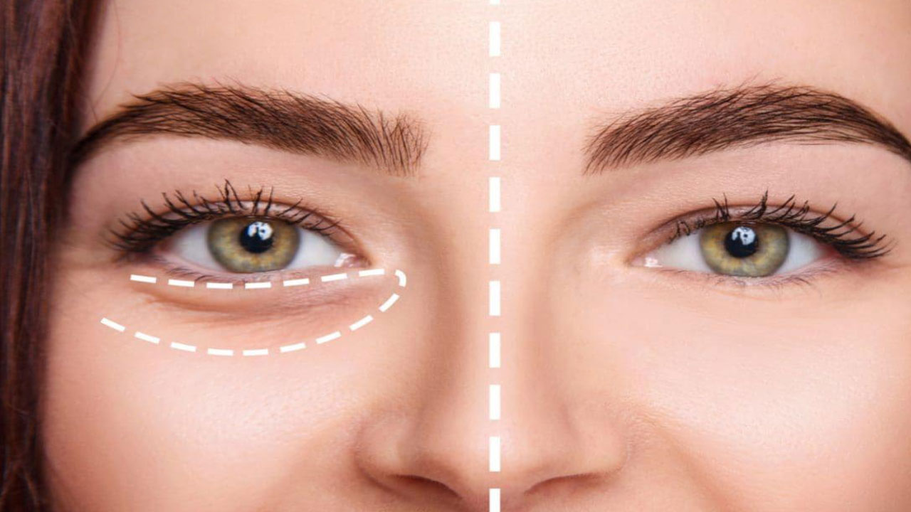 فیلر زیر چشم در اراک – بررسی 4 نکته مهم